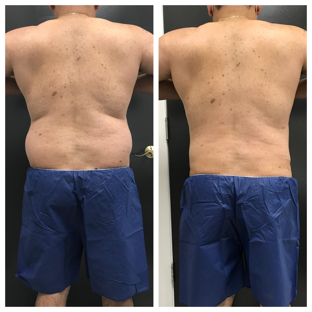 Liposuction For Obese Men Liposuction For Obese Men