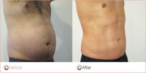 Liposuction And Cosmetic Surgery Institute Insights