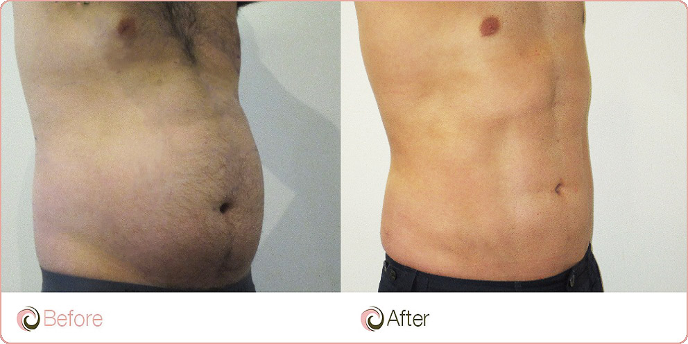 Liposuction And Cosmetic Surgery Institute Insights