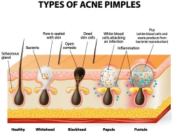 Acne Scars Cosmetic Surgery Options For Skin Renewal