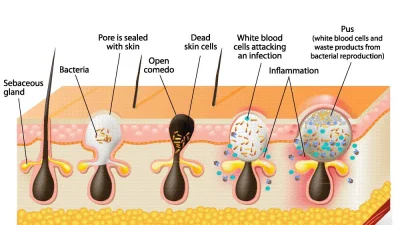 Acne scars cosmetic surgery