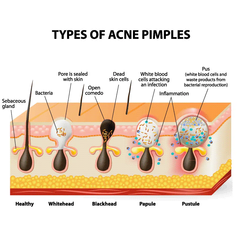 Acne scars cosmetic surgery