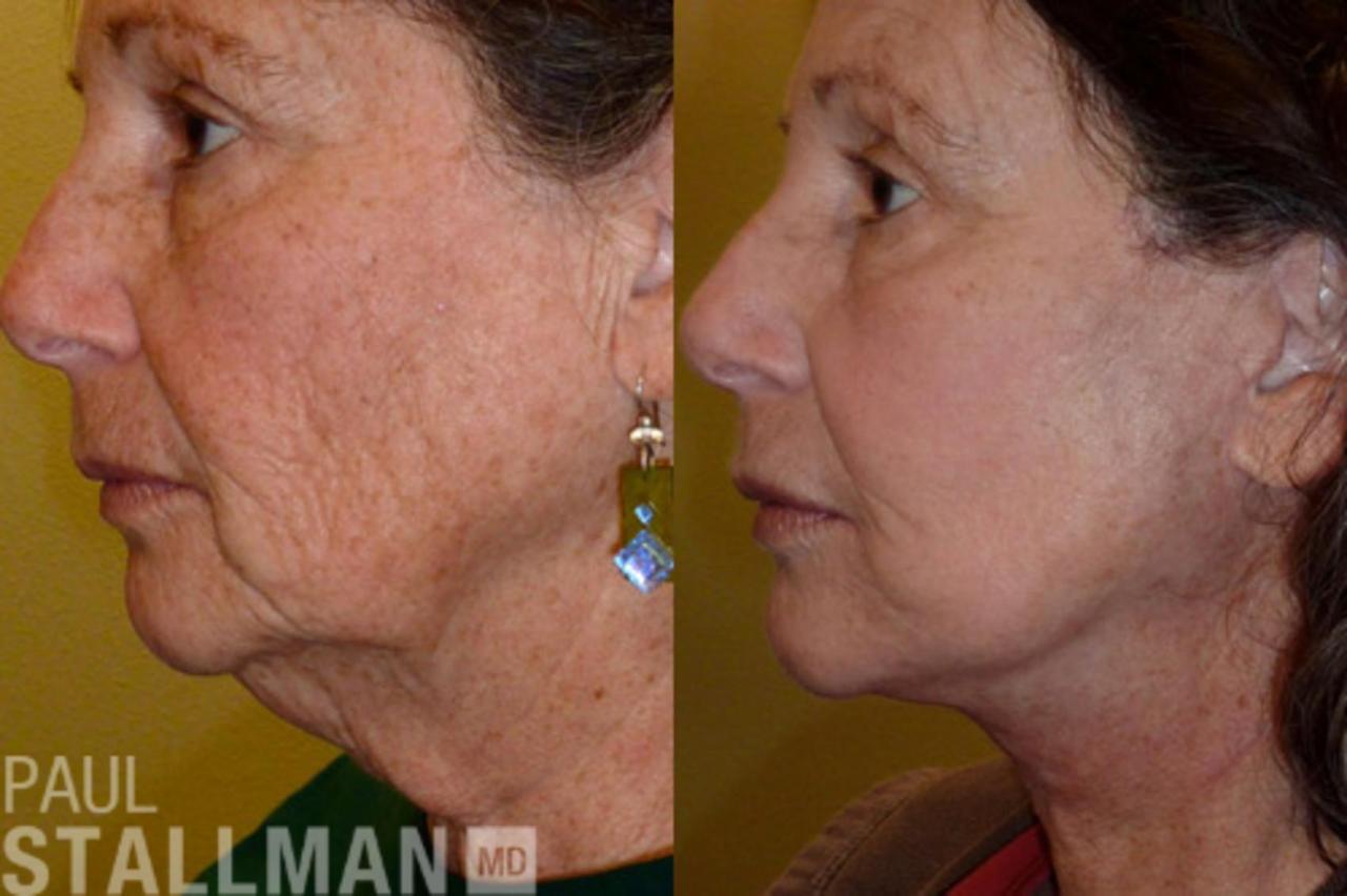 Fresno cosmetic surgery