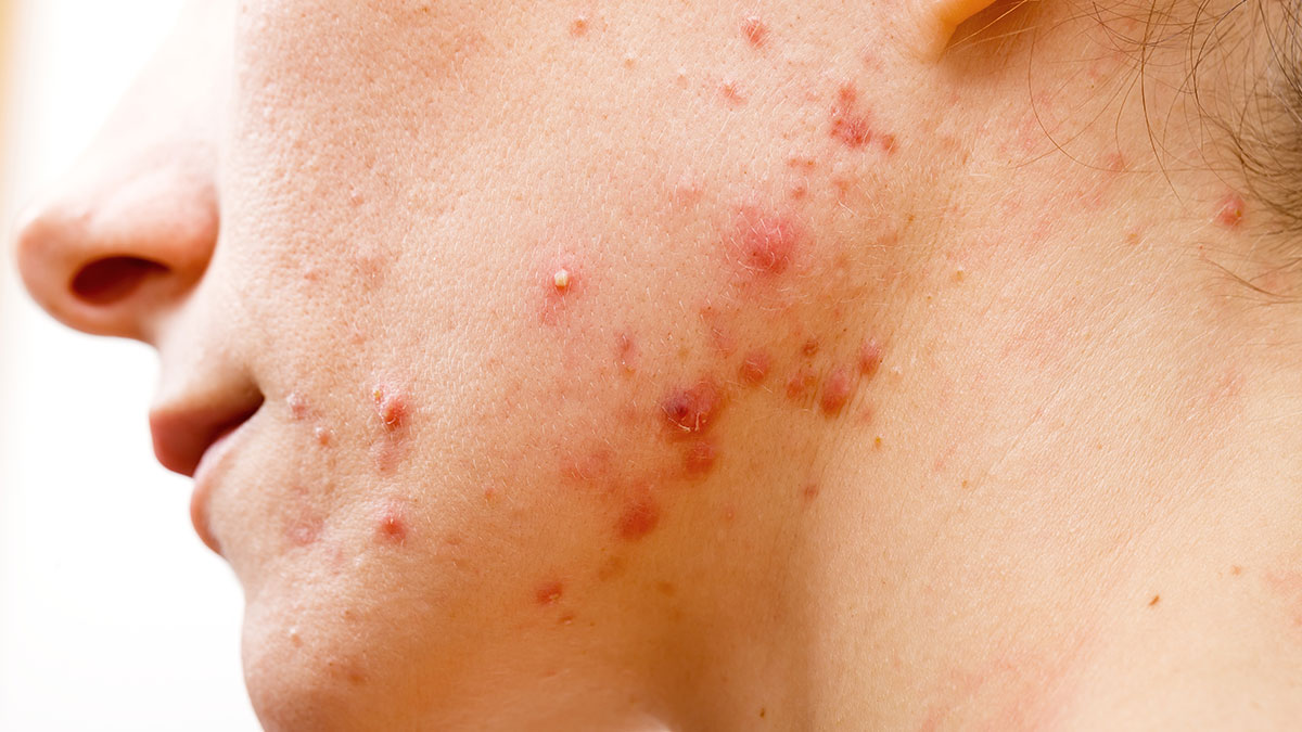 Understanding The Basics of Acne - Olay.com Understanding The Basics of Acne - Olay.com