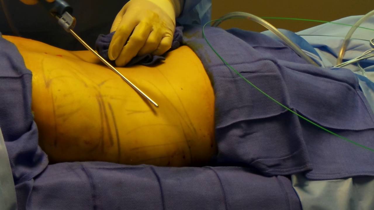Liposuction In Abdomen- Abdominal Surgery At Venkat Center Liposuction In Abdomen- Abdominal Surgery At Venkat Center
